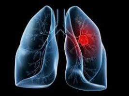 عوامل ایجاد سرطان ریه ، درمان در منزل سرطان ریه
