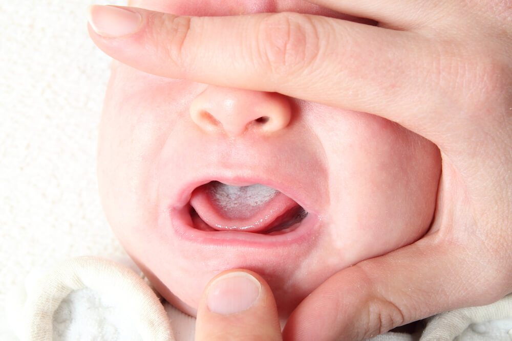 عکس برفک دهان نوزاد ، علائم ، تشخیص ، درمان ، پیشگیری