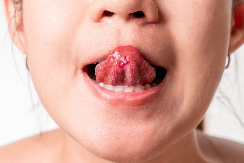 بیماری برفک دهان چیست ؟ برفک دهان کودک ، نوزاد یا در کودکان و نوزادان