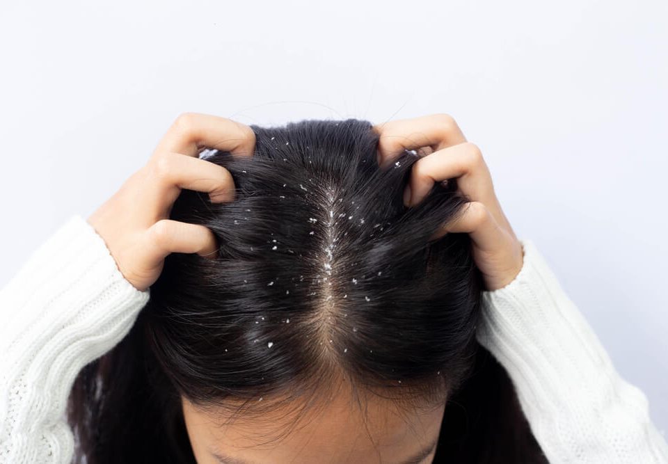 درمان شوره سر موهای چرب