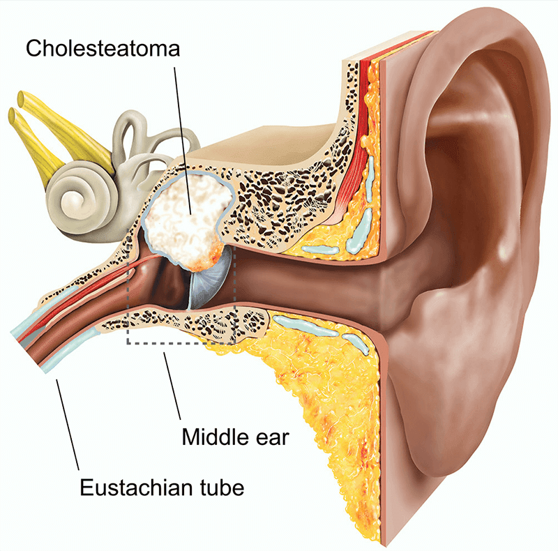 کلستاتوم یا کیست گوش چیست